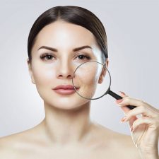 How to Revitalize Your Skin Using Laser Acne Scar Treatment