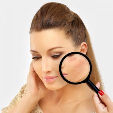 Everything You Should Know about Laser Acne Scar Removal 