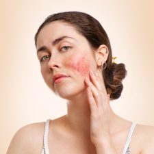 Getting Diagnosed by an Experienced Professional Helps with Facial Redness Treatment