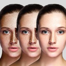 How to Get Rid of Dark Spots with PicoSure Laser
