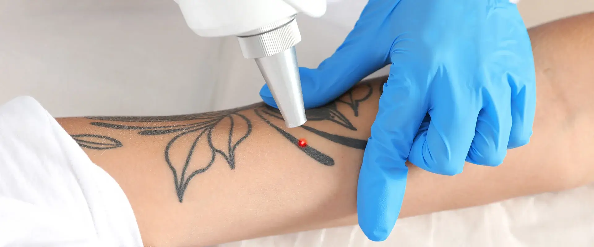 Tattoo removal session at medispa in Glendale using advanced laser technology