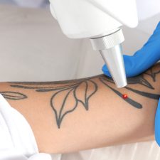 What Is the Safest Form of Tattoo Removal?