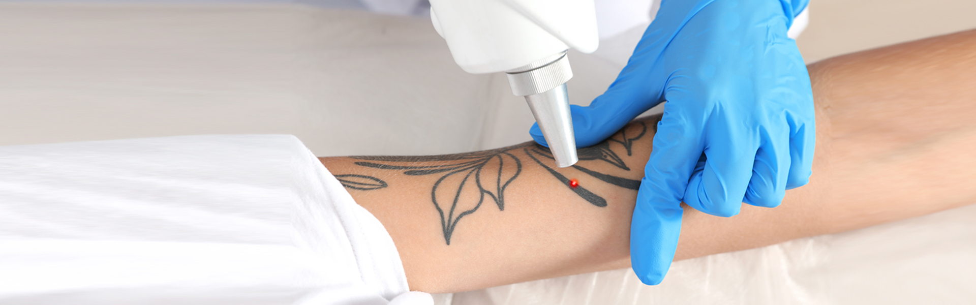 Tattoo Removal
