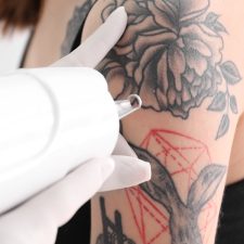 Why PicoSure is the Best Tattoo Removal Laser