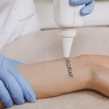 The Benefits of Laser Tattoo Removal Over Other Methods