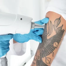 How Many PicoSure Sessions Are Needed for Tattoo Removal?
